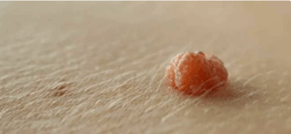 Virus do papiloma