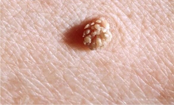 papiloma