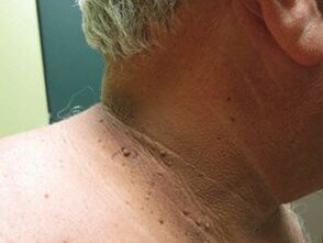 As razóns para a aparición de papilomas plurais no corpo