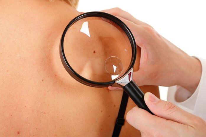 Exame dun paciente con VPH