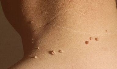 causas dos papilomas