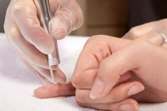 como desfacerse dos papilomas do corpo