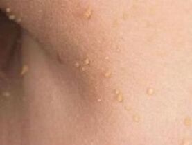 razóns para a aparición de papilomas no corpo