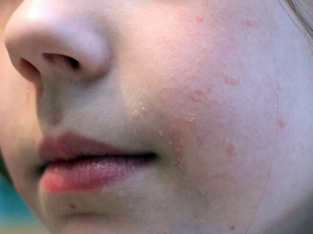 As verrugas planas na cara aparecen con máis frecuencia durante a adolescencia