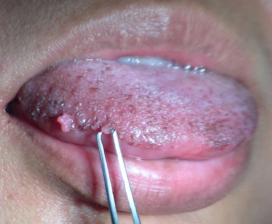 Papilomas na lingua